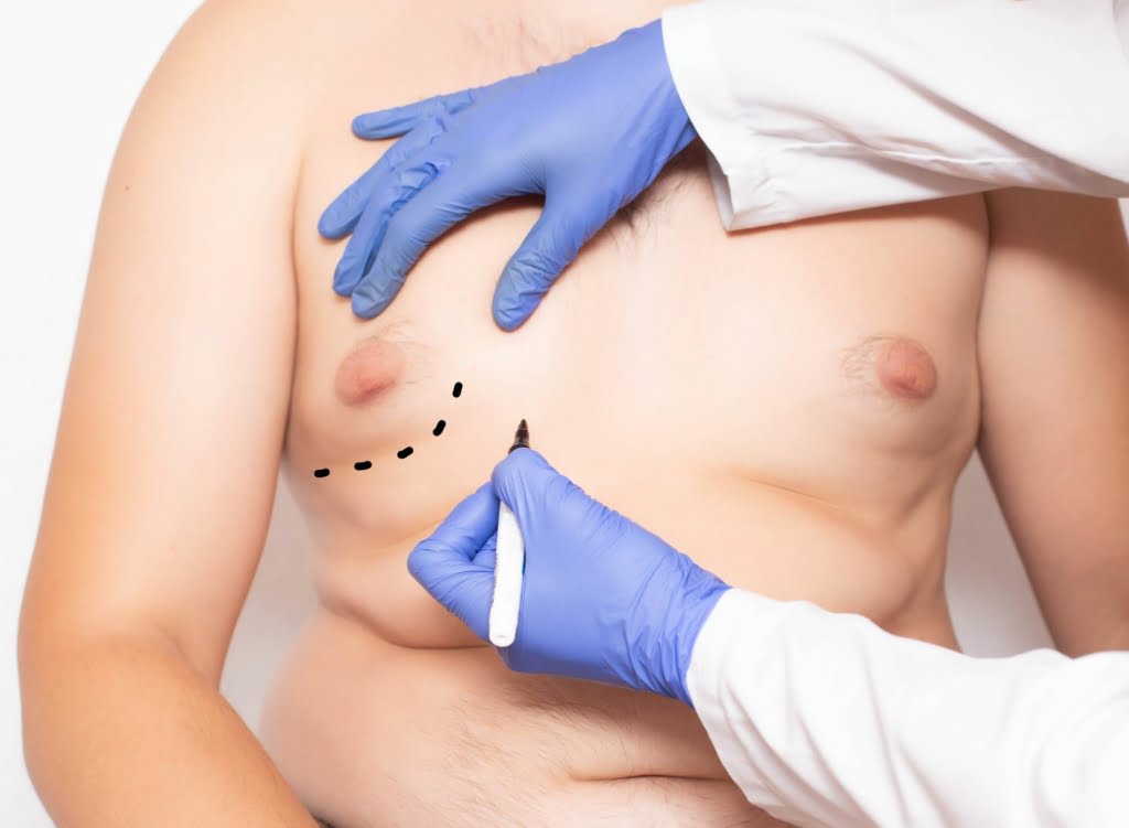 Γυναικομαστία