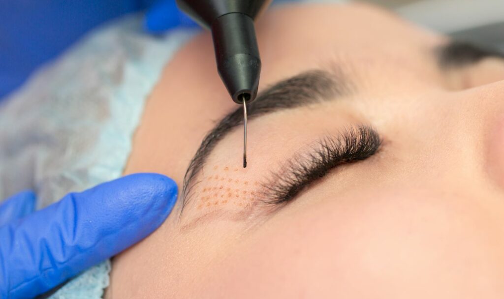 Αναίμακτη Βλεφαροπλαστική (Plasma Technology)