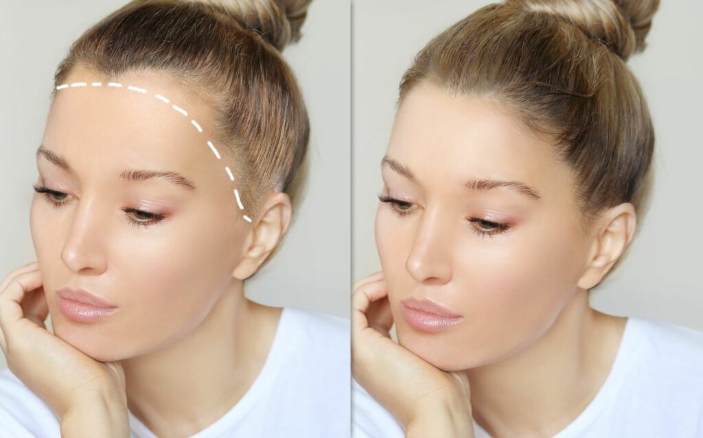 Μεταμόσχευση Μαλλιών